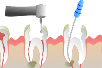 ENDODONTIA